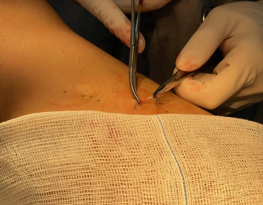 Microcirurgia de varizes